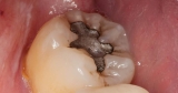 CDC Data Show Toxic Mercury Exposures from Dental Mercury Amalgam Fillings Pose Risk to Majority of Americans