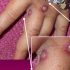 Health News Roundup: WHO says monkeypox outbreak ‘containable’, confirms 131 cases outside Africa; Pfizer ulcerative colitis drug leads to remission in a third of patients -study and more