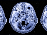 Scientist discover the brain cells that drive overeating