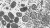 CDC: Florida infant younger than 2 months had monkeypox