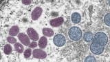 First monkeypox case in Colorado announced, waiting for CDC confirmation
