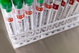 WHO says monkeypox is not yet a health emergency