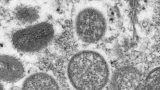 Monkeypox Precautions Advised at Summer Gatherings as Chicago Reports 5 New Cases – NBC Chicago