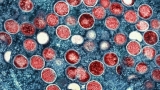 How K-12 schools are planning for monkeypox outbreaks as a new year starts