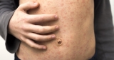 At least 82 children in Ohio infected with measles, more than half of whom are unvaccinated babies and toddlers