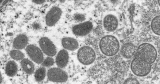 Monkeypox: What is it, and why is it spreading now?