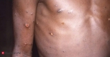 ‘Growing concern’ of Monkeypox in India?, Health News, ET HealthWorld
