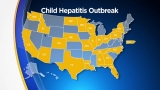 Colorado Doctors Warn Parents About Child Hepatitis As Cases Crop Up Across Nation – CBS Denver