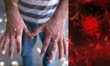 Monkeypox risk is higher in kids under 8