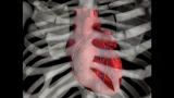 Combination ‘polypills’ can help solve world’s heart problems, experts say, if more people can get them