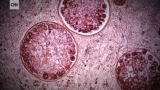 CDC says gay and bi men in Florida need the meningococcal vaccine, to keep them safe in ‘worst’ outbreak in US history