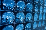 Global study, supported by Alzheimer’s Association, aims to shed light on COVID-19’s impact on the brain