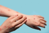 Monkeypox cases in the US have drastically decreased, CDC data shows (OTCMKTS:BVNRY)