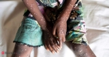 In Africa’s monkeypox outbreak, sickness and death go undetected, Health News, ET HealthWorld