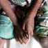 CDC Says We Probably Can’t Get Rid of Monkeypox Now