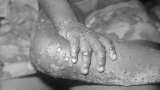 Experts Warn US Monkeypox Outbreak Might be “Out of Control” Already; WHO Records Over 5000 Global Cases | The Weather Channel – Articles from The Weather Channel
