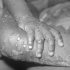 US Initiates Monkeypox Vaccine Rollout: What to Know About the Disease and Its Symptoms