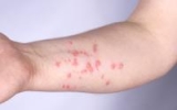 Monkeypox slows in UK, US as CDC notes diagnosis issues