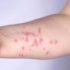 U.S. Declares Monkeypox a Public Health Emergency | Smart News