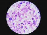 Acute myeloid leukemia (AML) morphology: What to know