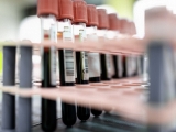 Blood test may predict long-term risk of diabetes and heart disease