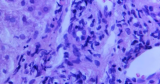 The CDC is reporting 36 more unexplained hepatitis cases in children