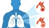 World Lung Cancer Day 2022: Know stages of lung cancer and at what stage can it possibly be cured