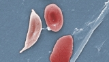 Sickle cell study: Too few kids with get stroke screening, treatment, CDC finds