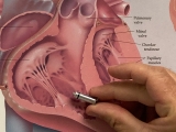 Bismarck patient receives smallest pacemaker in the world