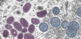 More cases of monkeypox identified in Minnesota – Duluth News Tribune