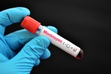 TN surpasses 50 monkeypox cases, says CDC