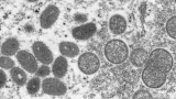 Is monkeypox a global emergency? WHO is considering it
