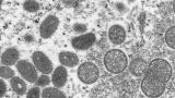 Monkeypox case confirmed in Brant County