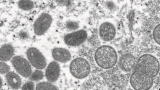 Monkeypox confirmed in person who used Toronto shelter system