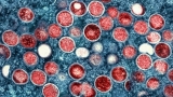 Third case of monkeypox reported in Guelph
