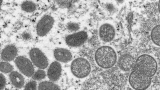 Florida Department of Health, CDC investigating a presumptive case of monkeypox