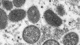 Health News – CDC investigating monkeypox in the U.S.