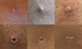 Monkeypox outbreak ‘is containable’ says World Health Organization