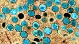 White House names co-ordinator to lead U.S. response to monkeypox
