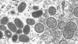 World Health Organization monitoring 250+ monkeypox cases