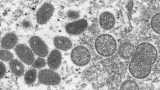 CDC: 6 monkeypox cases in Minnesota
