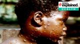 Explained: What is monkeypox, a smallpox-like disease from Africa that has been reported in the UK?
