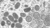 Maine officials confirm first pediatric case of monkeypox