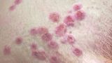 Toronto confirms 3 more monkeypox cases, bringing city’s total to 5