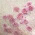 Tennessee reports 10 cases of monkeypox, per CDC