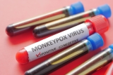 Alarm bells as SA records 5th Monkeypox case
