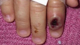 CDC confirms 6 monkeypox cases in Mississippi