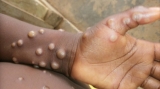 With 2 more, India records 8 monkeypox cases