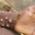 What to Know About Omicron’s BA.5: Symptoms, Testing and More