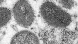 Second case of monkeypox in Columbus area